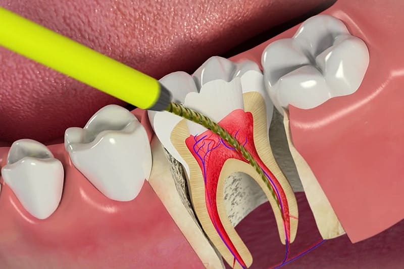 Endodontija Rīgā: zobu kanālu ārstēšana